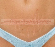 before treatment of stretch marks